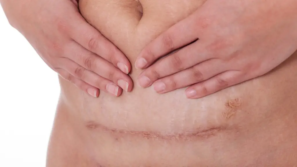 c-section scar