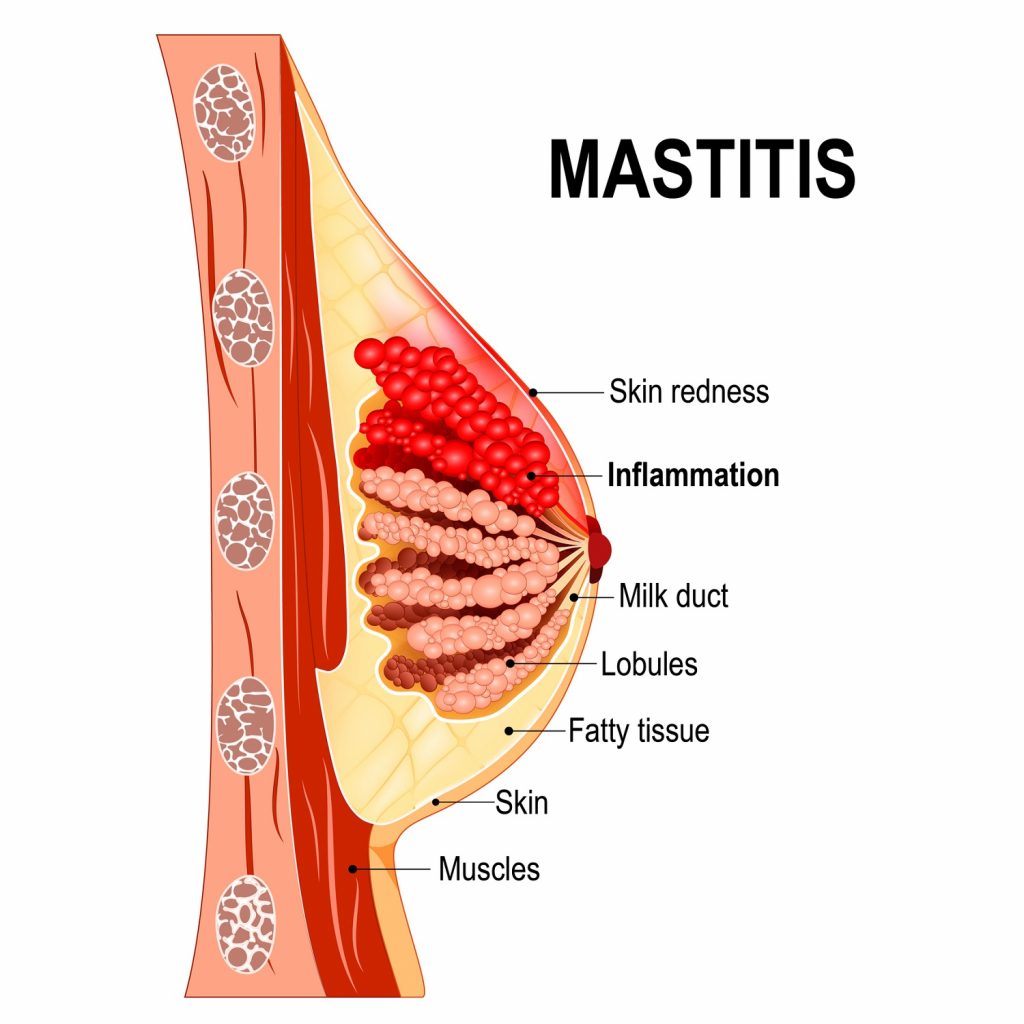 mastitis when feeding baby itchy breast